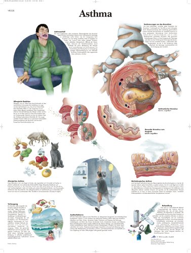 3B Scientific Lehrtafel - Asthma von 3B Scientific