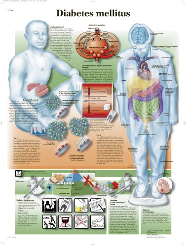 3B Scientific Lehrtafel Diabetes mellitus 3B Scientific Lehrtafel Diabetes mellitus von 3B Scientific