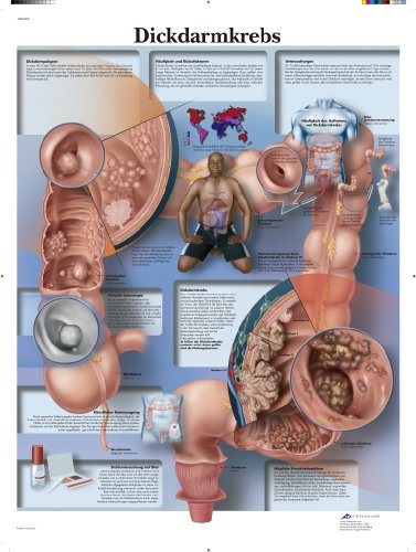 3B Scientific Lehrtafel - Dickdarmkrebs von 3B Scientific