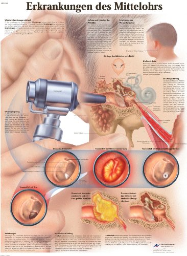 3B Scientific Lehrtafel - Erkrankungen des Mittelohrs von 3B Scientific