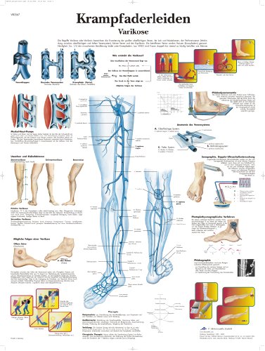 3B Scientific Lehrtafel - Krampfaderleiden, Varikose von 3B Scientific