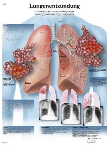 3B Scientific Lehrtafel - Lungenentzündung von 3B Scientific