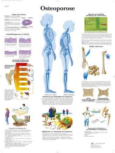 3B Scientific Lehrtafel - Osteoporose von 3B Scientific