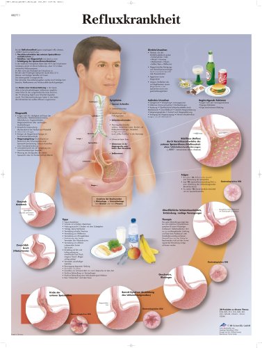 3B Scientific Lehrtafel - Refluxkrankheit von 3B Scientific