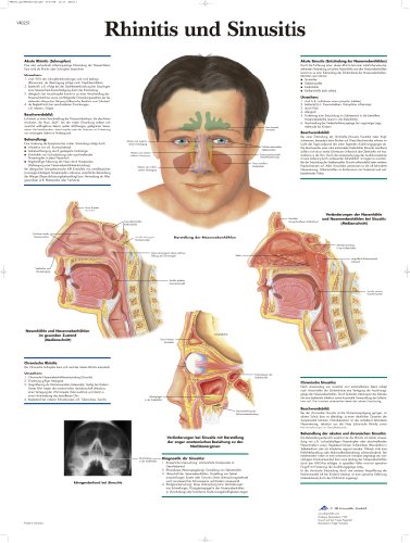 3B Scientific Lehrtafel - Rhinitis und Sinusitis von 3B Scientific