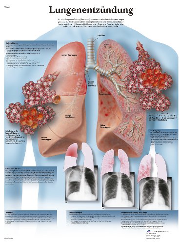 3B Scientific Lehrtafel laminiert - Pneumonie von 3B Scientific