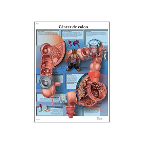 3B Scientific Lehrtaffel laminiert - Cáncer de colon - Spanisch 3B Scientific Lehrtaffel laminiert - Cáncer de colon - Spanisch von 3B Scientific