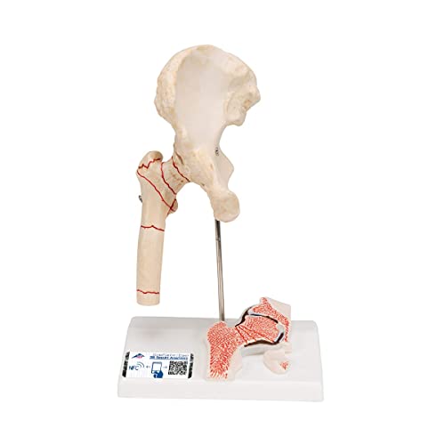 3B Scientific Menschliche Anatomie - Oberschenkelbruch und Hüftgelenkverschleiß + kostenlose Anatomie App - 3B Smart Anatomy von 3B Scientific