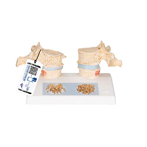 3B Scientific Menschliche Anatomie - Osteoporosemodell + kostenlose Anatomie App - 3B Smart Anatomy von 3B Scientific