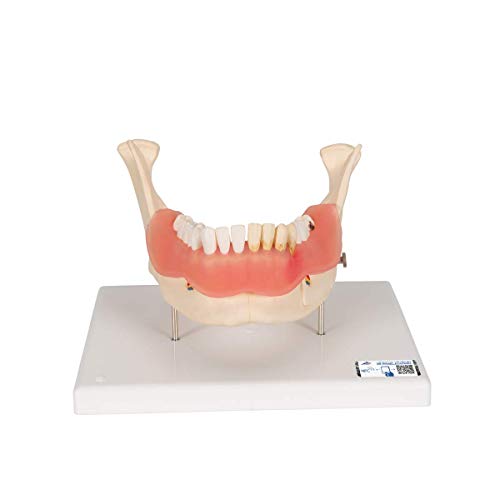 3B Scientific Menschliche Anatomie - Zahnerkrankungsmodell, 2-fach vergrößert, 21-teilig + kostenlose Anatomie App - 3B Smart Anatomy von 3B Scientific