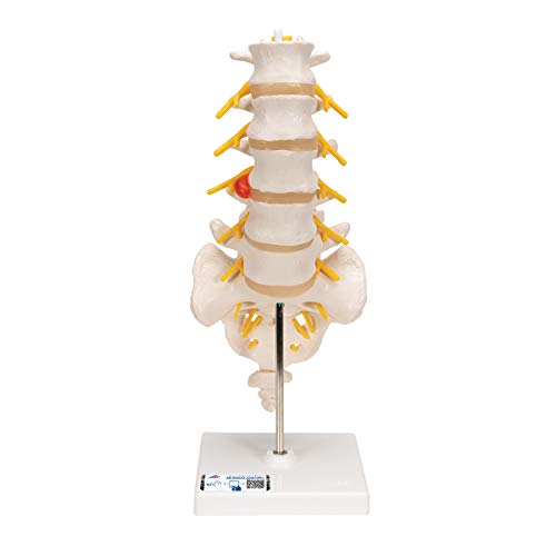3B Scientific Menschliche Anatomie - Lendenwirbelsäule mit dorsolateralem Bandscheibenvorfall + kostenlose Anatomie App - 3B Smart Anatomy von 3B Scientific