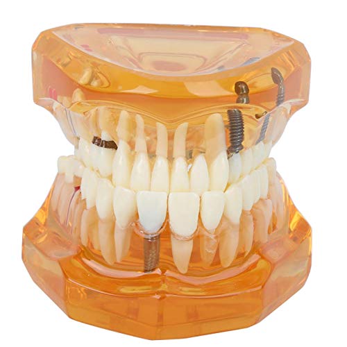 Zähne Modell Farbe Zahnkrankheit abnehmbar Studie Lehre Zähne Modell für Home Office Schule Krankenhaus Orangefarben von Ailao