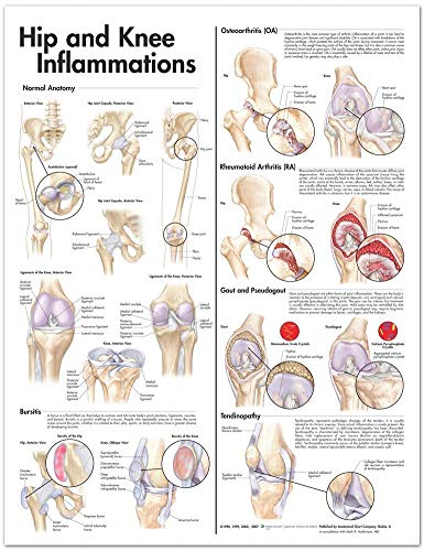 Hip and Knee Inflammations Anatomical Chart von Anatomical Chart