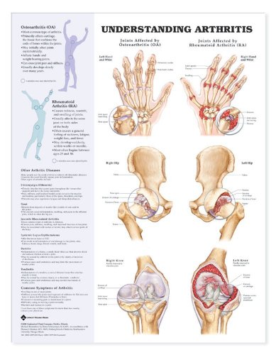 Understanding Arthritis Anatomical Chart von Anatomical Chart