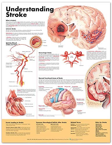 Understanding Stroke Anatomical Chart von Anatomical Chart