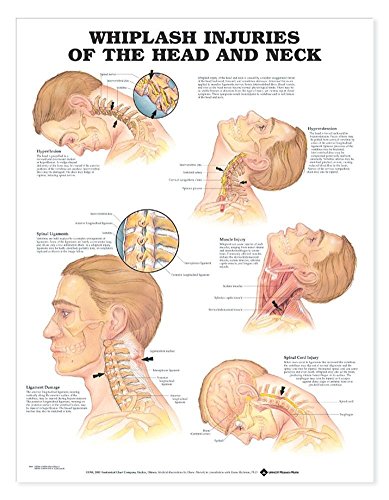 Whiplash Injuries of the Head and Neck Anatomical Chart von Anatomical Chart