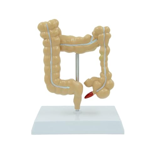 BYERZ Menschliche Kolorektale Läsion Modell Pathologische Anatomie Dickdarm Krankheiten Darm Anatomisches Modell Medizinische Studie Tool von BYERZ