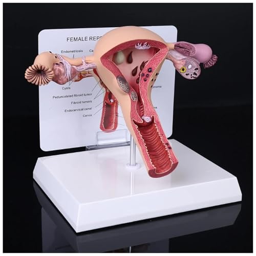 Modell der pathologischen und normalen Gebärmutter, Modell der weiblichen Geschlechtsorgane, Anatomische Gebärmuttermodelle, mit Schaukarton und Sockel, für den schulischen Unterricht(A) von COUCHO