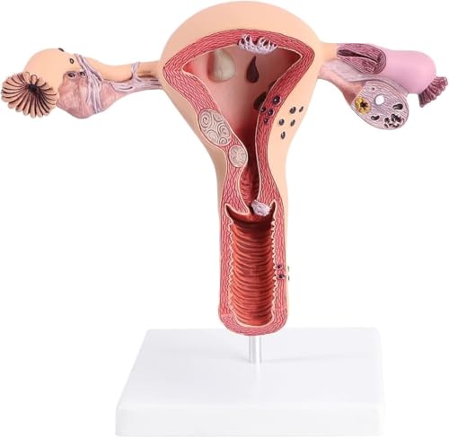 Pathologisches Gebärmutter-Eierstock-Modell, Anatomiemodell der weiblichen Geschlechtsorgane, for den Schulunterricht, Lehrmittel zur Reproduktionsmedizin Pathologisches Gebärmutter-Eierstock-Modell, Anatomiemodell der weiblichen Geschlechtsorgane, for den Schulunterricht, Lehrmittel zur Reproduktionsmedizin von COUCHO