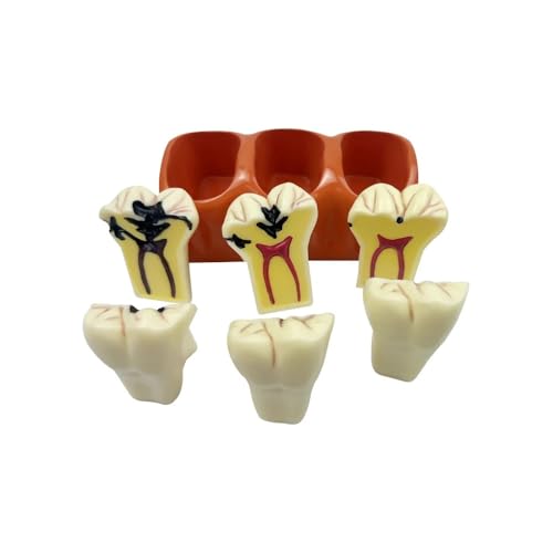 Cherrynight XLJP 1pc Dental Education Modell 4 Mal Karies Evolution Modell Zahn Karies Vergleich Demonstration Modell Demonstration Cherrynight XLJP 1pc Dental Education Modell 4 Mal Karies Evolution Modell Zahn Karies Vergleich Demonstration Modell Demonstration von Cherrynight