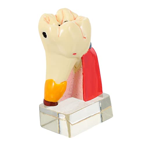 Ciieeo Zahnmodell Karies Demonstrationsmodell für und Unterricht Anatomisches Zahnmodell zur Kariesbehandlung Leichtes Education Tooth Model für Schule und von Ciieeo