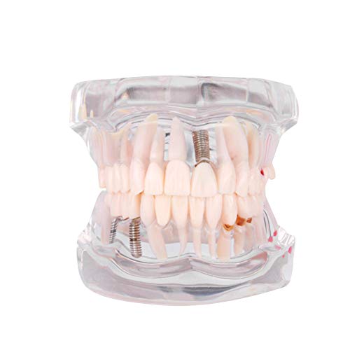 Cocoarm Zahnpflege Modell Abnehmbare Zahnmodell Arzt Demo Implant Zahnarzt Lehr Studie Modell Transparent Lehrwerkzeug für Zahnarztdemonstration von Cocoarm