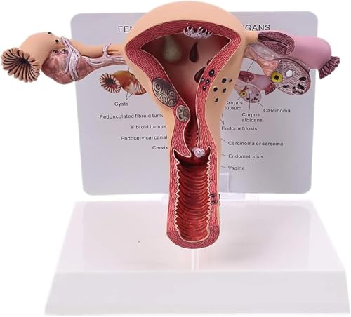 DRFGHK Female Uterus Ovary Model, Pathology Model of Human Female Uterus Ovary Disease Dissection Biology Teaching Aid Anatomy Lesion Uterus DRFGHK Female Uterus Ovary Model, Pathology Model of Human Female Uterus Ovary Disease Dissection Biology Teaching Aid Anatomy Lesion Uterus von DRFGHK