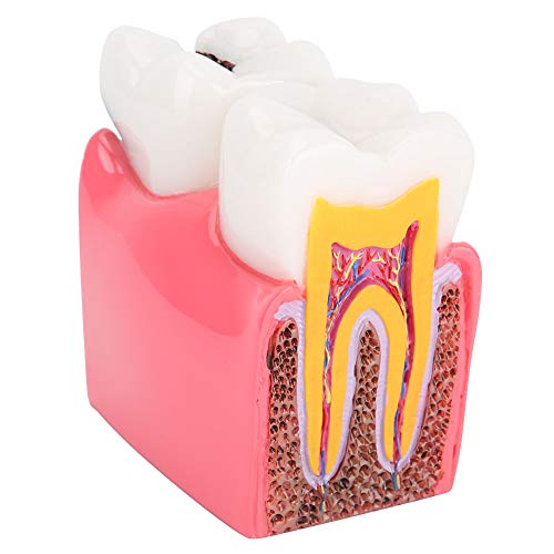 EIMSOAH Zahnkaries-Vergleichsstudienmodelle, Zahnarzt-Zahnanatomie-Bildungs-Zahnmodell mit Querschnittsmodell von Zahnschmelz, Dentin, Pulpa, Zement usw. für das Dentallabor von EIMSOAH