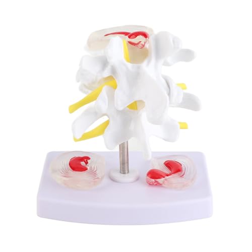 Fyearfly Menschliches Lendenwirbelmodell,Bandscheibenvorfall modell, Anatomisches wirbelsäule modell für Schulungsmaterial von Fyearfly