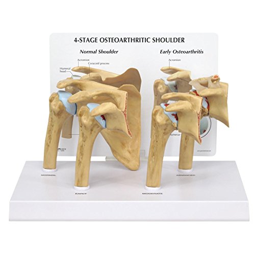 GPI Anatomicals 1800 Schuler Modell, Arthrose 4 Stadien von 3B Scientific