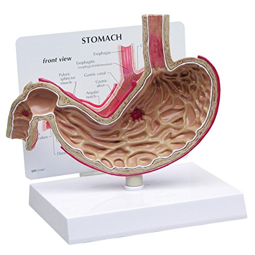 GPI Anatomicals 2000 Magen Modell mit Geschwür von 3B Scientific