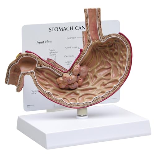 GPI Anatomicals 2001 Magenkrebs Modell von 3B Scientific