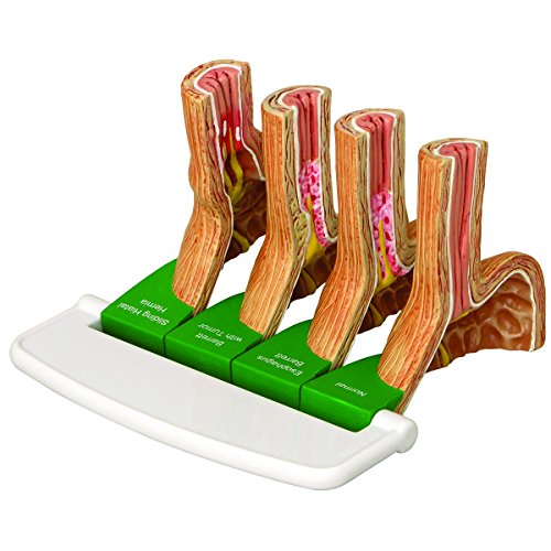 GPI Anatomicals 2010 Gastroösophageale Refluxkrankheit von 3B Scientific