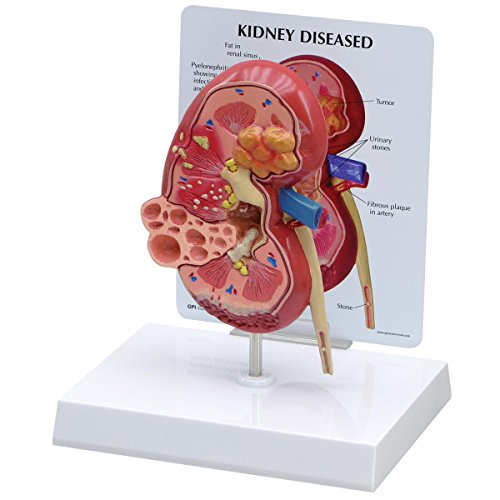 GPI Anatomicals 3260 Niere Modell normal mit Erkrankung von 3B Scientific