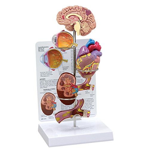 GPI Anatomicals 4000 Bluthochdruck Modell GPI Anatomicals 4000 Bluthochdruck Modell von 3B Scientific