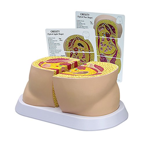 GPI Anatomicals W33363 Fettleibigkeit Modell von 3B Scientific