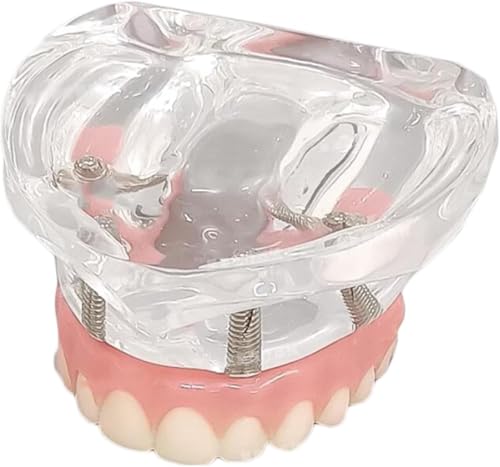 HGAYUBDV Zahnzahnmodell, Zahnimplantatmodell mit Brückenprothese, Erwachsenenzähne, Oberkiefer, 4 Implantate, Brücke mit Titan, transparente Basis. von HGAYUBDV