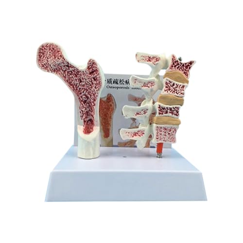 Menschliche Anatomie Osteoporosia-Modell für den Unterricht Display Osteoporosia Wirbelsäule Wirbel Anatomisches Skelett Menschliche Anatomie Wirbel Anatomisches Skelett für Studium Menschliche Anatomie Osteoporosia-Modell für den Unterricht Display Osteoporosia Wirbelsäule Wirbel Anatomisches Skelett Menschliche Anatomie Wirbel Anatomisches Skelett für Studium von HUAJINGKEJI