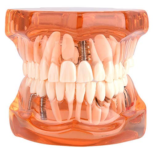 Jadeshay Zahnmodell Dentalmodell, Entfernbares Zahn-Implantat Lehrmodell Zahnarzt Demonstration Werkzeug für Zahn Schulstudien-Unterricht(orange) von Jadeshay