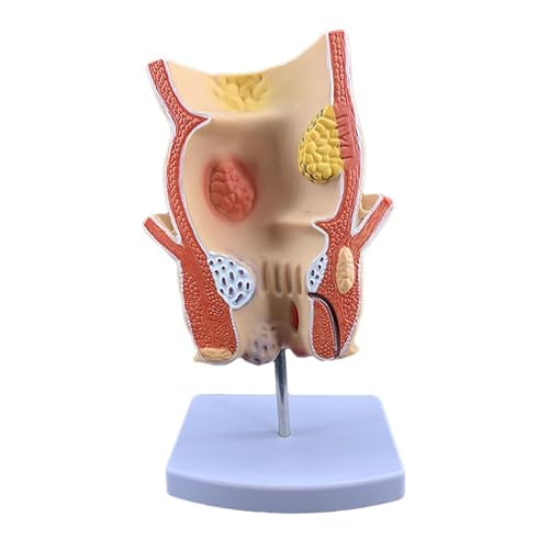 1 stück Simulierte Rektal Pathologie Modell Darm Proben Menschliches Anatomisches Modell Hämorrhoiden Anal Pathologie Medizinische Lehrmittel 1 stück Simulierte Rektal Pathologie Modell Darm Proben Menschliches Anatomisches Modell Hämorrhoiden Anal Pathologie Medizinische Lehrmittel von KXJSYL Tool