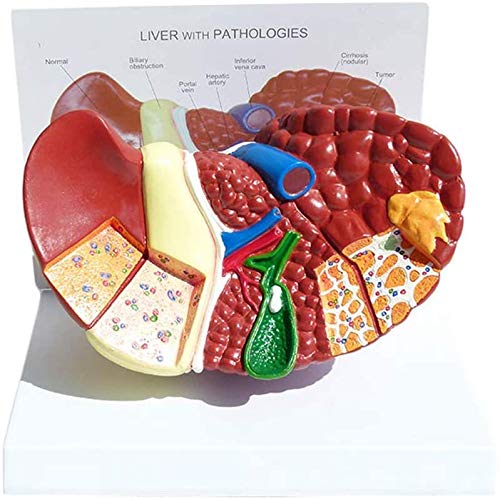 Anatomisches Modell Der Menschlichen Leber - Struktur Anatomische Pathologie Anatomie 3D Leberläsionen Auf Den Modellen Der Leber-Krebs Für Die Ausbildung Anatomisches Modell Der Menschlichen Leber - Struktur Anatomische Pathologie Anatomie 3D Leberläsionen Auf Den Modellen Der Leber-Krebs Für Die Ausbildung von LBYLYH