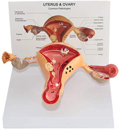 Bildungsmodell anatomisches Modell des weiblichen Uterus - anatomisches Modell der Ovarian Läsion pathologischer inneren Geschlechtsorgane zu medizinischen Ausbildung gynäkologischen von LBYLYH