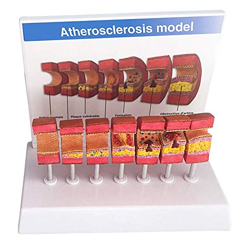 LBYLYH Anatomisches Modell der Arterie - Anatomisches Gefäß-Atherosklerose-Thrombus-Gefäß-Modell Modell der menschlichen Arterie - für das Studien-Display Lehre Medizinisches Modell von LBYLYH