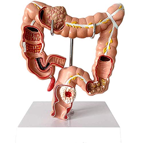 LBYLYH Anatomisches Modell des menschlichen Dickdarms - Modell der Darmläsion - Modell der anorektalen Gastroenterologie im Bereich des anatomischen Verdauungssystems des Dickdarmmodells von LBYLYH