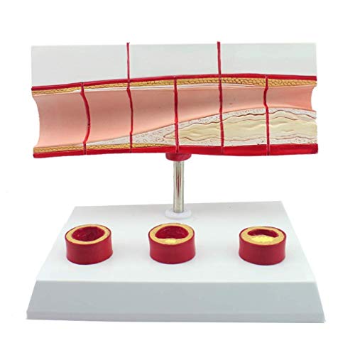 LBYLYH Arteriosklerose-Modell, Human-Atherosklerose-Herz-Kreislauf-Modell Blutgefäß Modell Medizinisches Lehrmaterial, 10-fache Lebensgröße. LBYLYH Arteriosklerose-Modell, Human-Atherosklerose-Herz-Kreislauf-Modell Blutgefäß Modell Medizinisches Lehrmaterial, 10-fache Lebensgröße. von LBYLYH