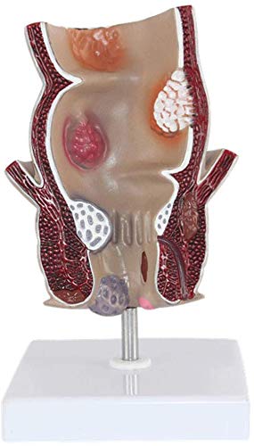 LBYLYH Modell Für Rektale Erkrankungen, Zeigt Häufige Analerkrankungen Wie Hämorrhoiden, Analfisteln, Fissuren, Colitis Ulceros, Darmkrebs von LBYLYH