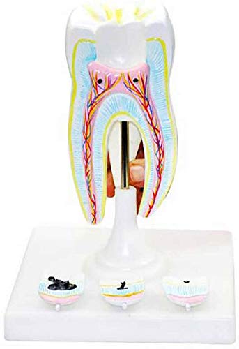 LBYLYH Modell des Zahnes - Modell mit Karies, Modell Anatomische Morphologie des Zahnes O-Abbau Learning Tool LBYLYH Modell des Zahnes - Modell mit Karies, Modell Anatomische Morphologie des Zahnes O-Abbau Learning Tool von LBYLYH