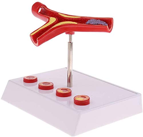 LBYLYH Thrombosis Thrombosis Atherosclerosis Anatomisches Menschliches Blut Querschnitt von Model Model Vascular, Scientific Anatomie Kit von LBYLYH