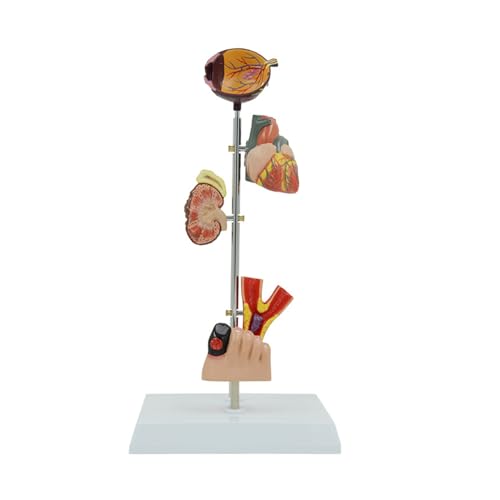 Pathologie Demonstration Anatomie Modell Pathologische Nierenanatomie Modell zeigt Symptome von Pathologie Demonstration Anatomie Modell Pathologische Nierenanatomie Modell zeigt Symptome von von LLINthy
