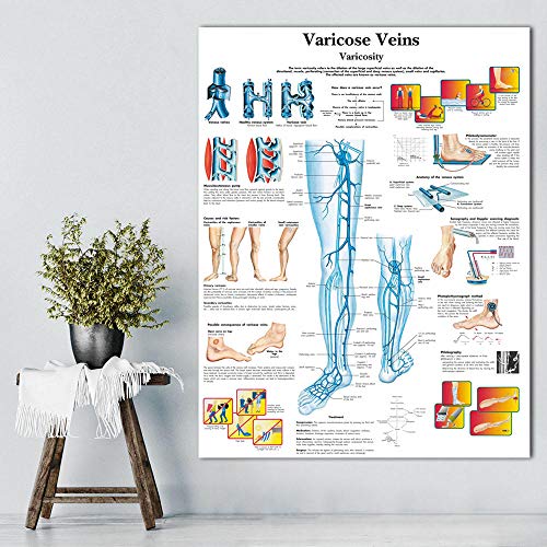 Bilder, Poster, Gemälde, Krampfadern Diagramm Poster Druck Leinwand Malerei Wandbilder Für Die Medizinische Ausbildung Ärzte Büro Klassenzimmer Poster Und Drucke - 50X70Cm von Ling88